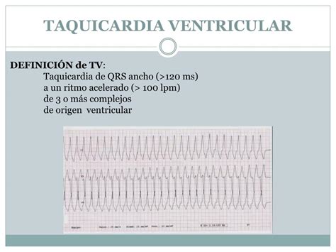 cie 10 taquicardia ventricular